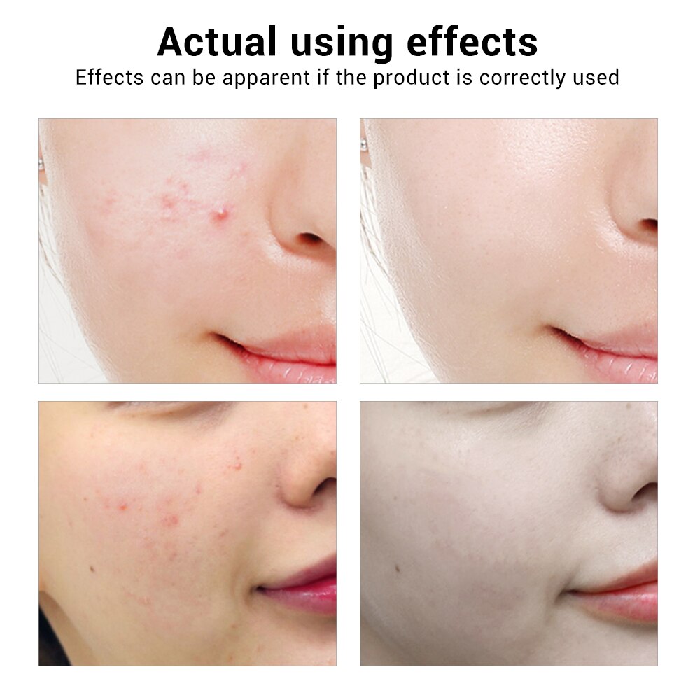 BREYLEE Acne Treatment Face Serum Mask Anti Acne Pimple Scar Remover Moisturizing Whitening Skin Care Facial Essence Cream 17ml (Chinese )