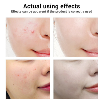 BREYLEE Acne Treatment Face Serum Mask Anti Acne Pimple Scar Remover Moisturizing Whitening Skin Care Facial Essence Cream 17ml (Chinese )